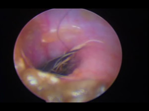 耳道奥深くに毛や耳垢が落ち込んでいます